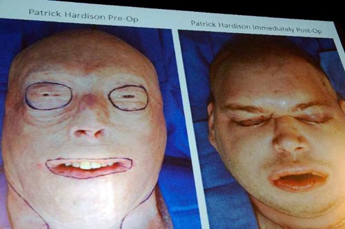 transplante de face